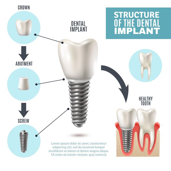 پوستر اینفوگرافیک آموزشی تصویربرداری پزشکی ساختار ایمپلنت دندان با مدل های ابزار سالم جایگزین مولی