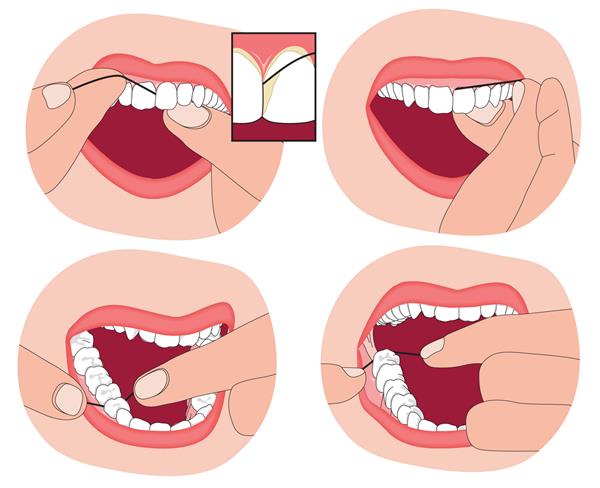 نخ دندان کشیدن نشان دادن مواد نخ دندان بین دندانها و به لثه اطراف