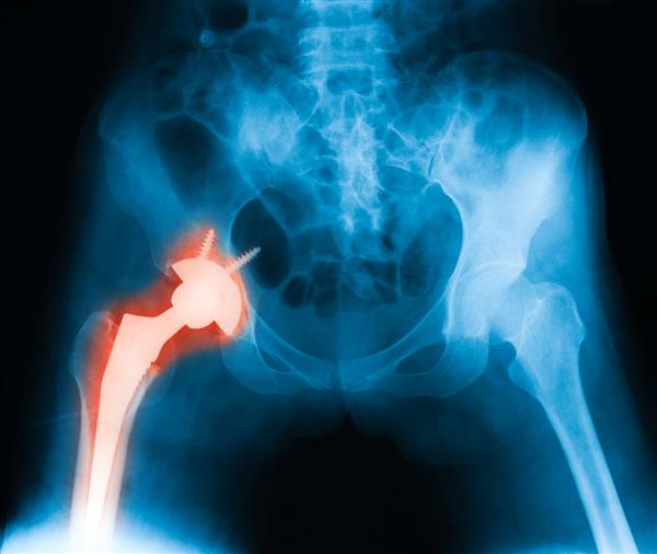 تصویر اشعه ایکس فوری بعد از عمل از هر دو مفصل ران نمای قبل از خلف