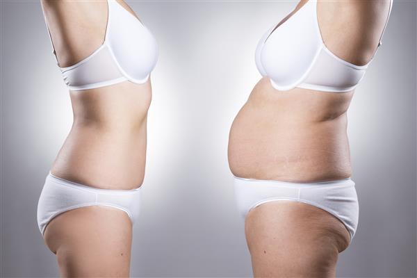 بدن زنان قبل و بعد از کاهش وزن روی زمینه خاکستری