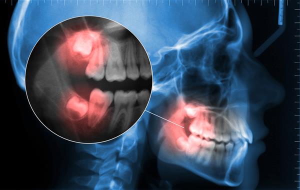 سفالومتریک و نمایش دندان درد