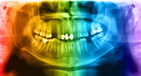 دندان های اشعه ایکس جمجمه انسان فک پایین عکس منفی پانوراما تصویر چهره دهان مرد جوان بزرگسال تصویربرداری از تجهیزات سیستم دیجیتال برای معاینه تشخیصی دندانپزشکی هنگام معاینه بالینی انجام شده است