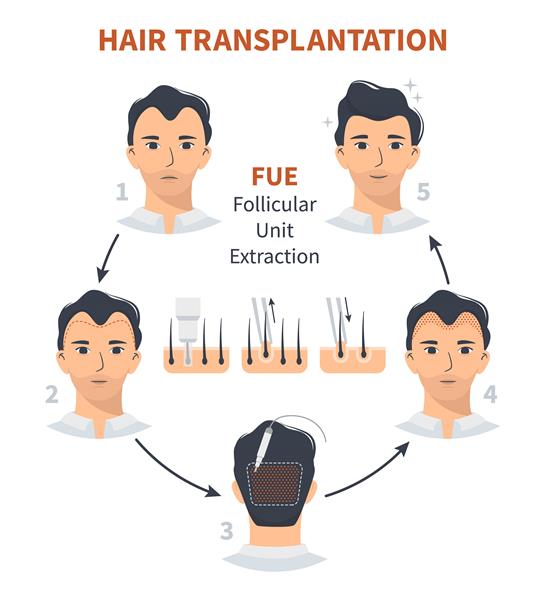 مراحل پیوند مو استخراج واحد فولیکول فوئول
