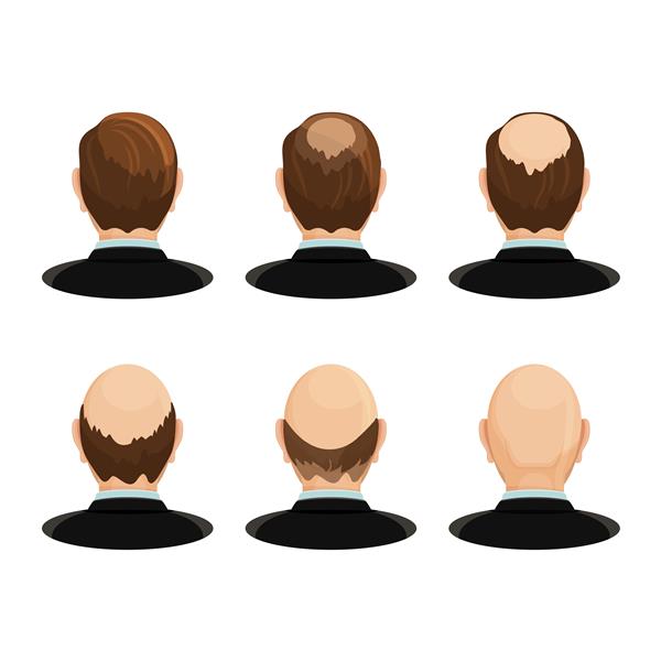 مفهوم آلوپسی مجموعه ای از سرها نشان دهنده پیشرفت ریزش مو است