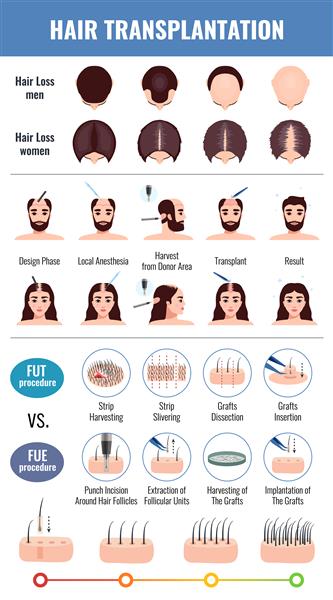 روش های کاشت مو با طاسی مردان و زنان با عناصر اینفوگرافیک جدا شده