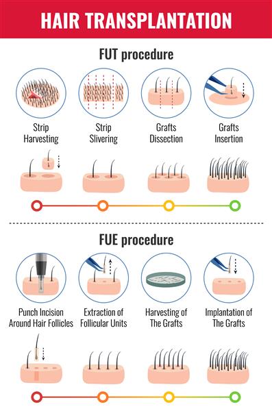 روشهای کاشت مو با مراحل اینفوگرافیک روی سفید