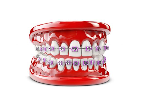 دندان با براکت مفهوم مراقبت از دندان تصویر سه بعدی