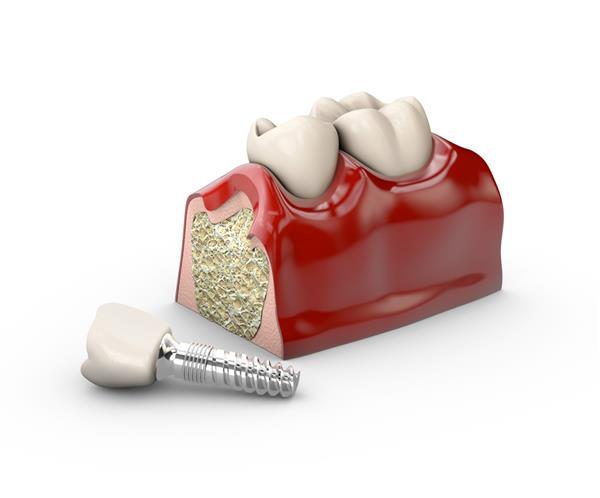 تصویر سه بعدی از مدل ایمپلنت دندان