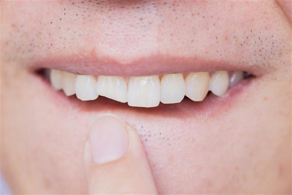 دندان های شکسته مرد آسیب دیده دندان جلویی ترک خورده نیاز به تعمیر و ترمیم دندانپزشک دارد
