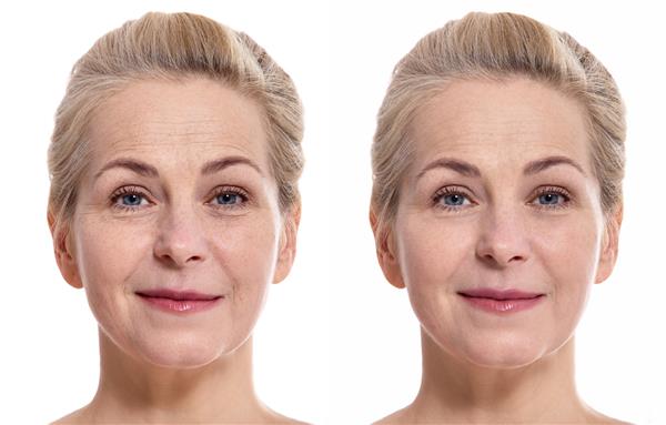 صورت زن قبل و بعد از عمل زیبایی مفهوم جراحی پلاستیک
