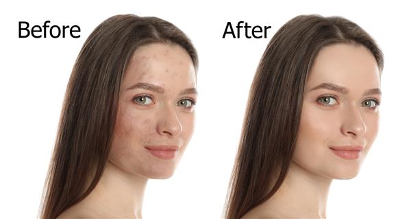زن جوان قبل و بعد از عمل زیبایی در زمینه سفید