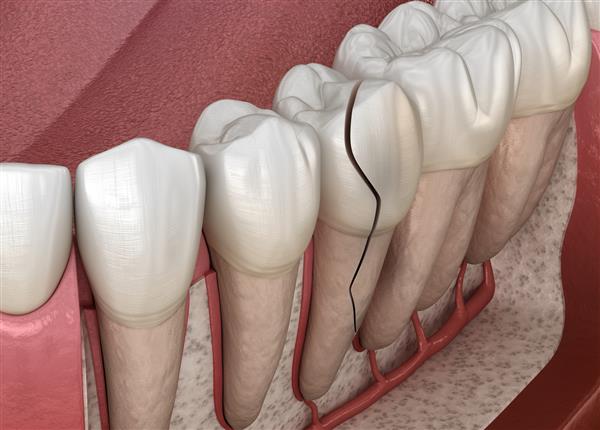 دندان ترک خورده شکافته تصویر سه بعدی دقیق پزشکی