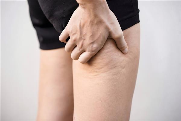 نمای نزدیک از دست زنی که پاها را با چربی سلولیت نگه می‌دارد و هل می‌دهد پوست پرتقال رژیم غذایی سالم رژیم غذایی ورزش کاهش چربی زیر پوست سلولیت چربی روی پاهای خانم ها