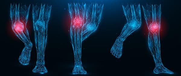 تصویر برداری چند ضلعی از پاهای انسان بیماری التهابی مفهوم مفصل زانو اندام تحتانی پلی آرت کم روی پس زمینه آبی تیره
