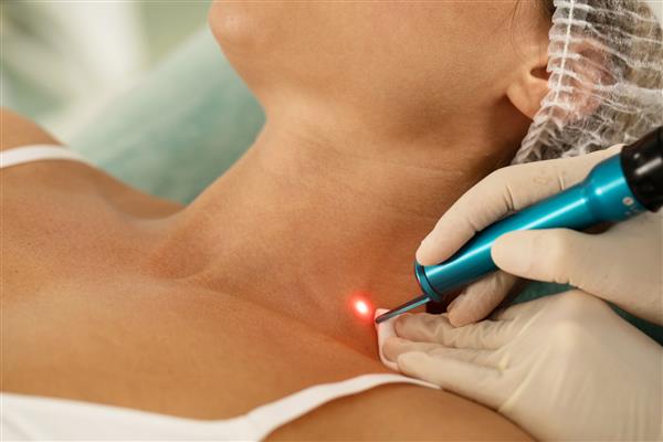 مراجعه کننده زن در حین حذف لیزر رنگدانه یا خال مادرزادی در یک کلینیک زیبایی پزشکی