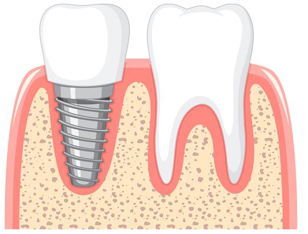 دندان سالم و ایمپلنت دندان در لثه در زمینه سفید