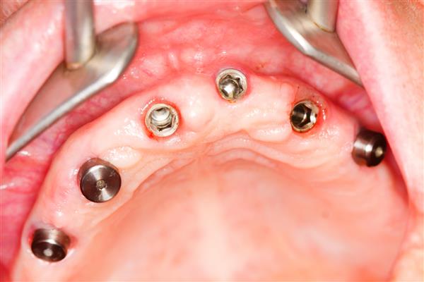 یک عکس ماکرو از ایمپلنت های دندانی در حفره دهان دهان انسان - کاف های لثه برای برداشتن برداشته می شود