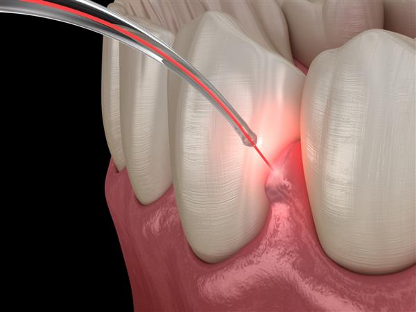 جراحی اصلاح لثه با لیزر تصویر سه بعدی دندان دقیق از نظر پزشکی