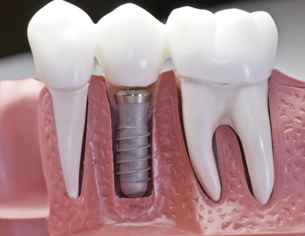 این مدل نشان می دهد که دندان ها کلاهک شده اند و سنجاق ضد زنگ در لثه ها وجود دارد