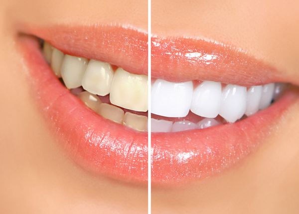 دندان های زن قبل و بعد از سفید کردن روی پس زمینه سفید