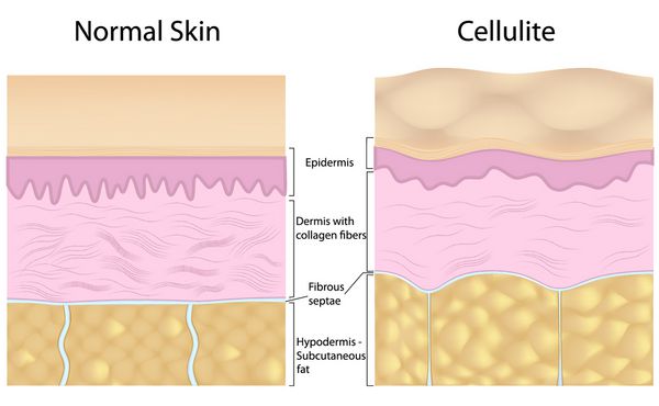 سلولیت در مقابل پوست صاف