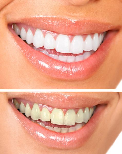 سفید کردن مراقبت از دندان زن سالم دندان های سفید