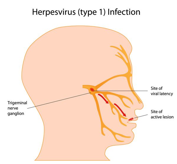 عفونت هرپس ویروس سرماخوردگی