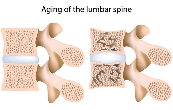 پوکی استخوان ستون فقرات کمری
