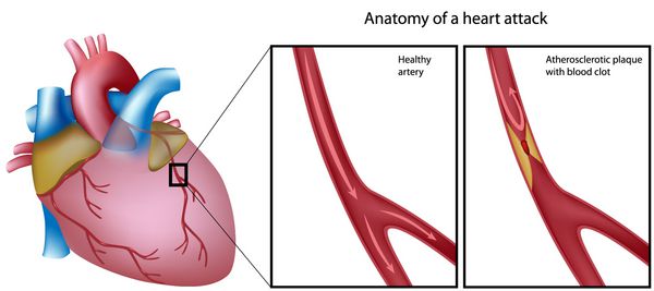 آناتومی حمله قلبی