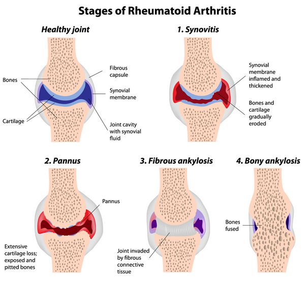 مراحل آرتریت روماتوئید در مفصل سینوویال