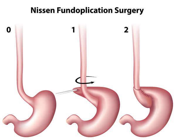 Nissen Fundoplication جراحی معده