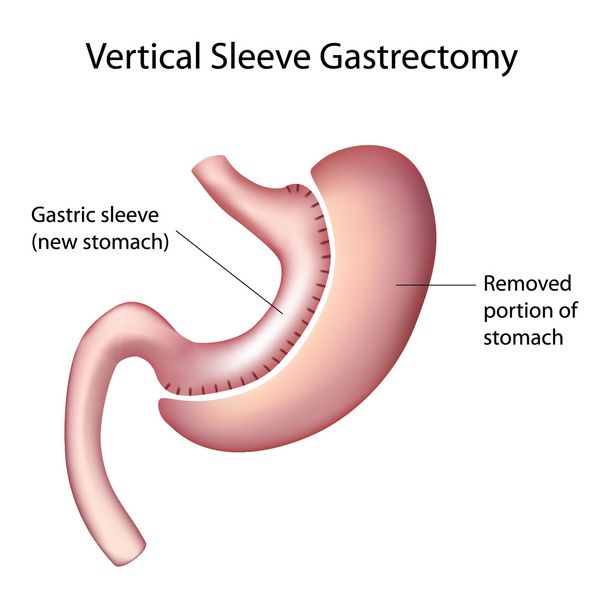 جراحی کاهش وزن گاسترکتومی آستین عمودی VSG
