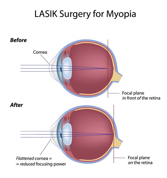 جراحی لیزیک چشم برای نزدیک بینی