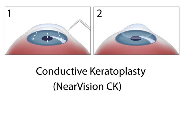 جراحی کراتوپلاستی رسانا چشم NearVision CK