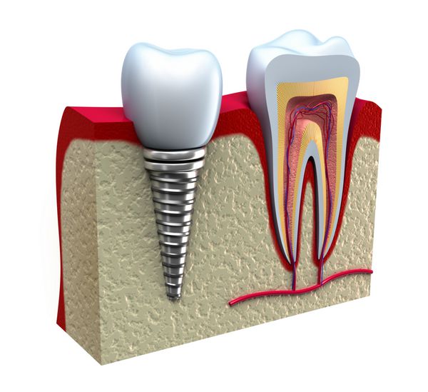 آناتومی دندان های سالم و ایمپلنت دندان در استخوان فک
