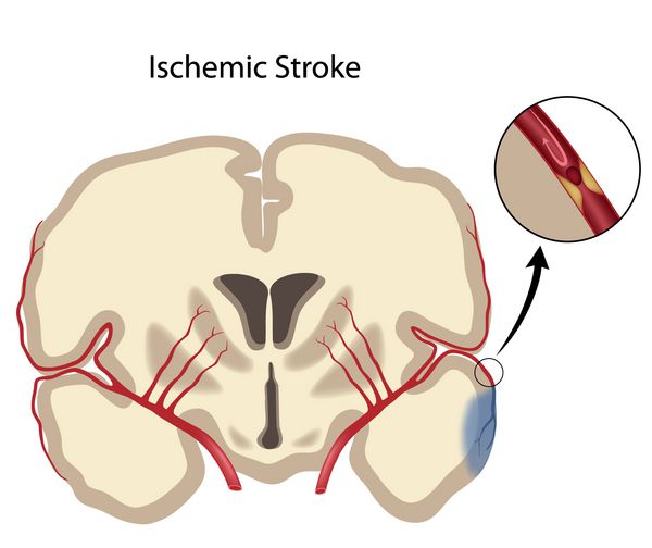 سکته مغزی ایسکمیک