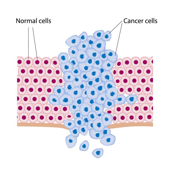 سلول های سرطانی در یک تومور در حال رشد