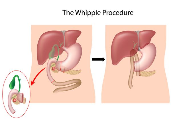 روش Whipple برای درمان سرطان در سر پانکراس