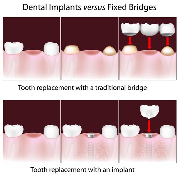 ایمپلنت های دندانی در مقابل بریج های ثابت