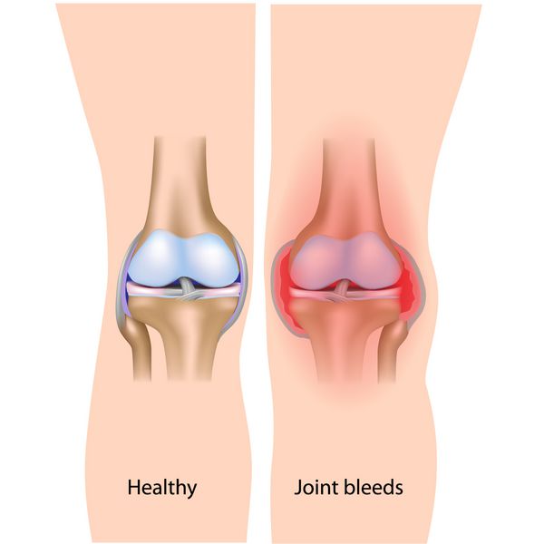 خونریزی مفاصل در هموفیلی