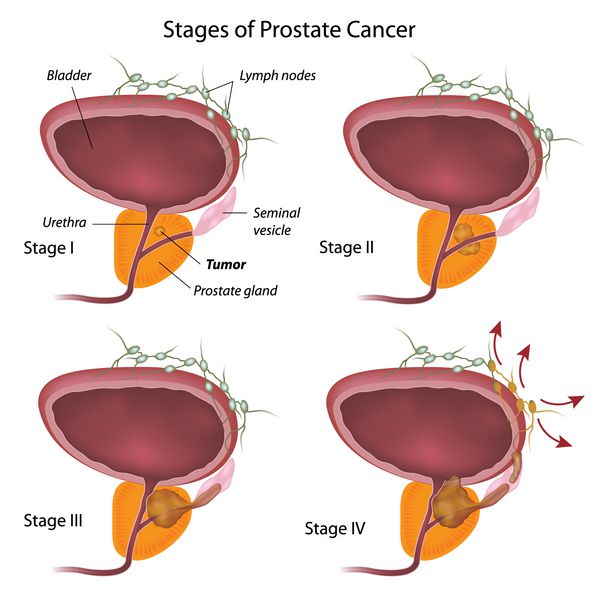 مراحل سرطان پروستات