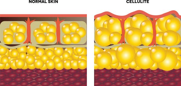 سلولیت و پوست معمولی