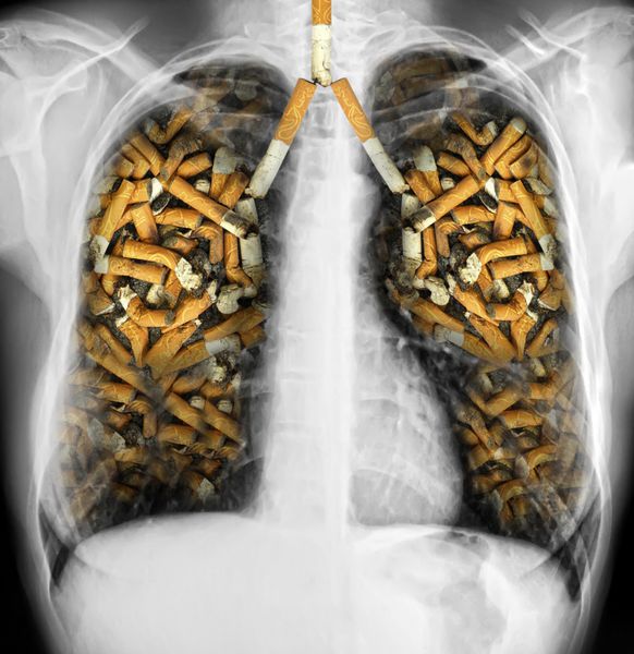 اشعه ایکس قفسه سینه انسان با اثرات سیگار کشیدن - سرطان ریه