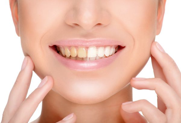 بخشی از نمای نزدیک صورت لبخند دندانی مفهوم قبل و بعد از بلیچینگ