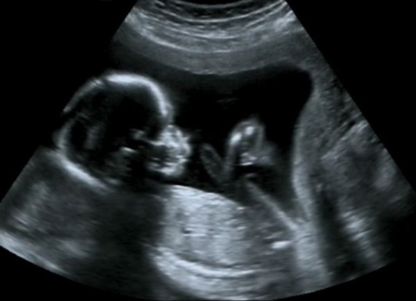 سونوگرافی مامایی جنین در ماه چهارم اسکن اکوگرافی