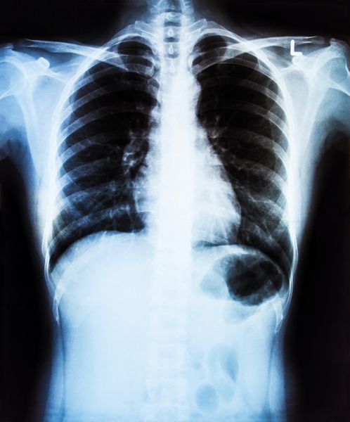 تصویر اشعه ایکس از قفسه سینه انسان برای تشخیص پزشکی