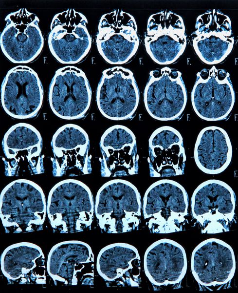 اسکن MRI از مغز انسان
