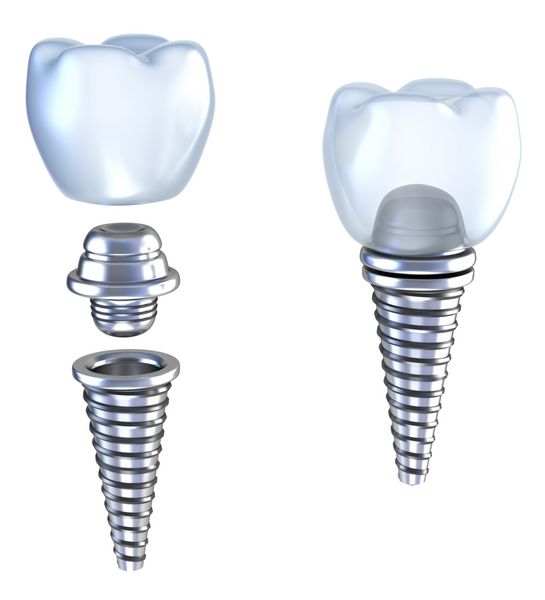 تاج سه بعدی ایمپلنت دندان با پین ایزوله شده روی سفید