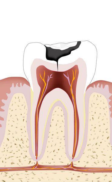 Zahn mit Karies Endodontie 1