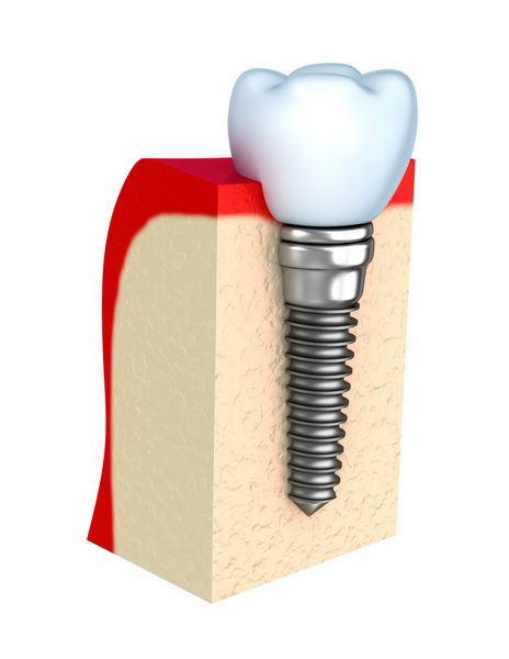 ایمپلنت دندان در استخوان فک